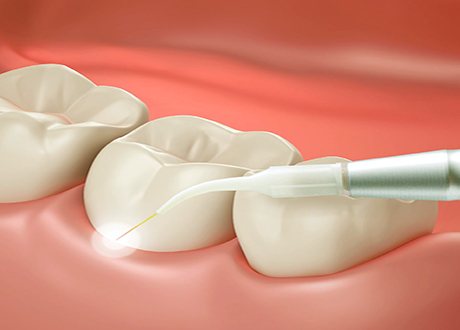Metal Dental Braces