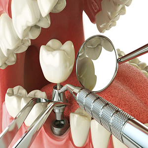 Dental Implantology